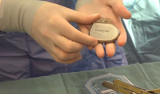 Image of bladder pacemaker device