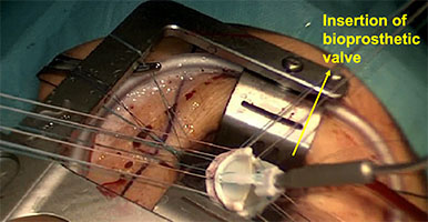 Aortic valve bioprosthetic insertion
