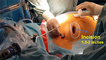 Mitral valve replacement incision