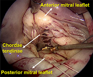 Labelled Mitral valve replacement