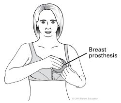 Line drawing of bra with prosthesis