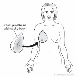 Line drawing of sticky prosthesis