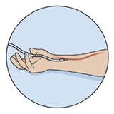 arterial line illustration