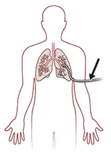 chest tube illustration