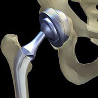 Hip Replacement, after surgery