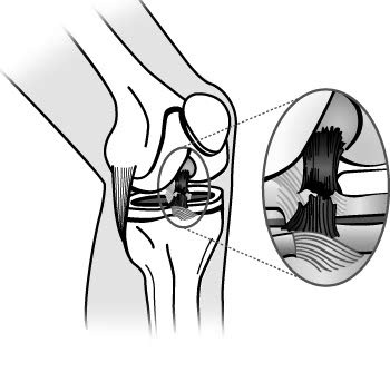 sketch of a torn ACL