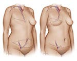 DIEP Surgery incisions and placement of tissue