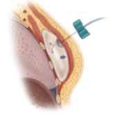 Normal saline is injected into the tissue expander to stretch the skin and muscle to create space for the permanent implant.