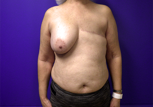 Before DIEP Surgery - Front View
