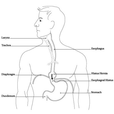 Esophagectomy