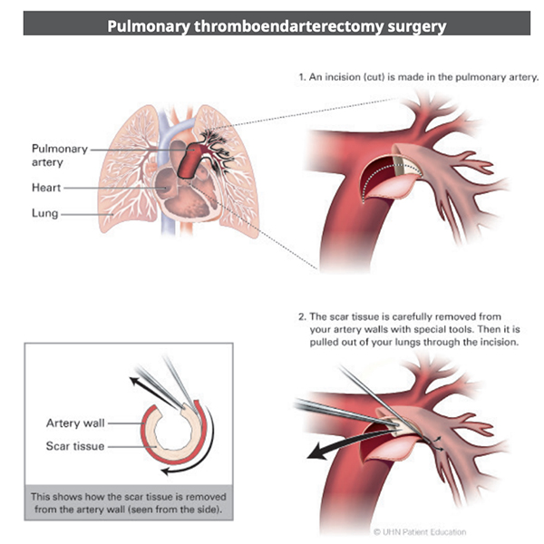Pulmonary thromboendarterectomy (PEA)