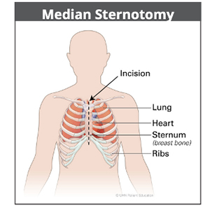 median sternotomy