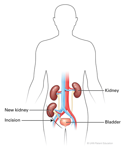 About the Operation - Kidney