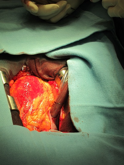 Coronary Artery Bypass Grafts