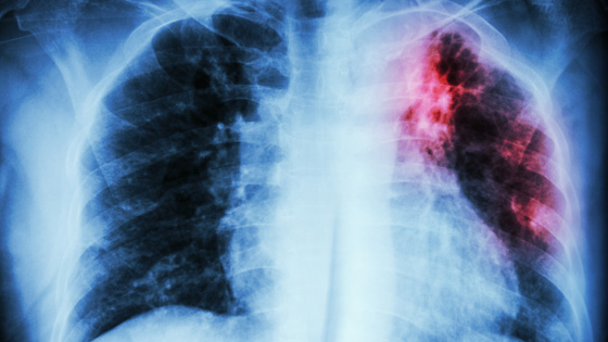Lung illustration 