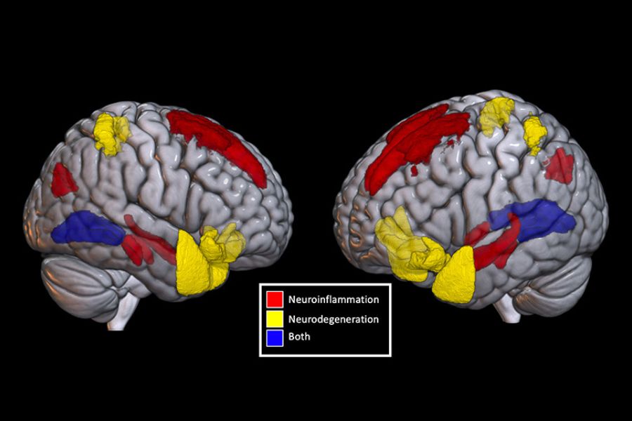 Two free-water diffusion MRIs the first non-invasive biomarker proposed to identify neuroinflammation