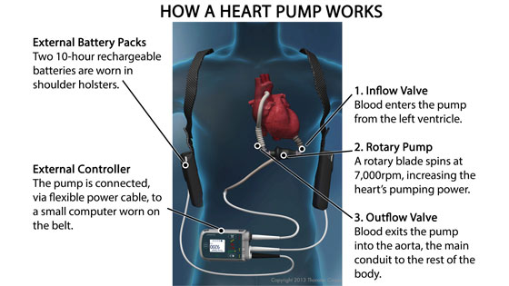 Graphic of Mechanical Heart 