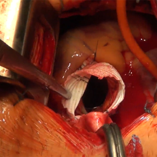 Minimally Invasive Aortic Surgery