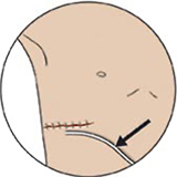 extrapleural catheter illustration