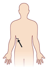 thoracotomy incision