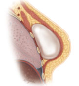 Permanent implant-based breast reconstruction
